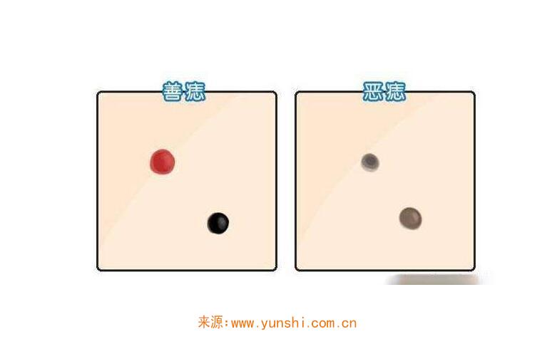 黑痣是善痣吗