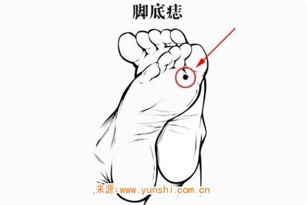 脚上有黑痣好吗